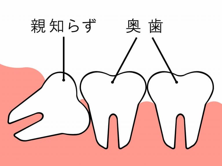 親知らずの抜歯