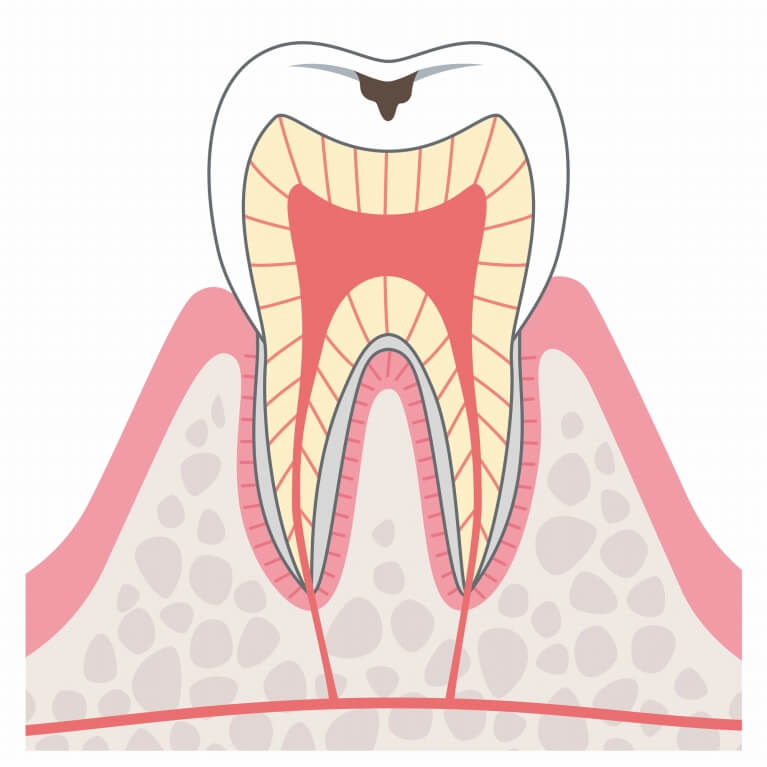 C1　エナメル質のむし歯
