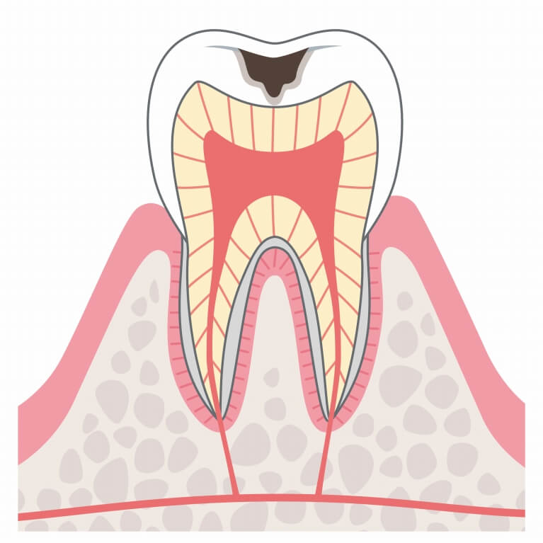 C2　象牙質のむし歯