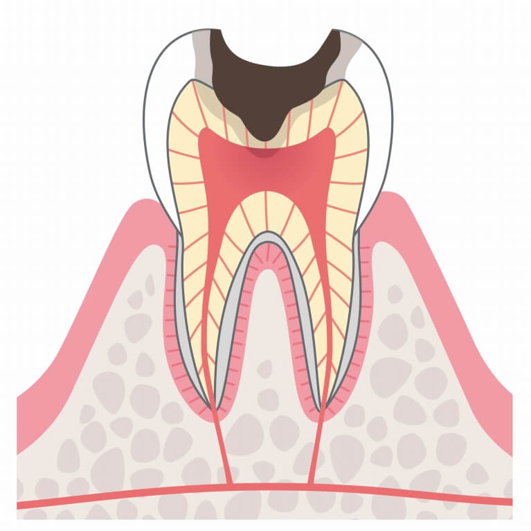 C3　歯の神経のむし歯