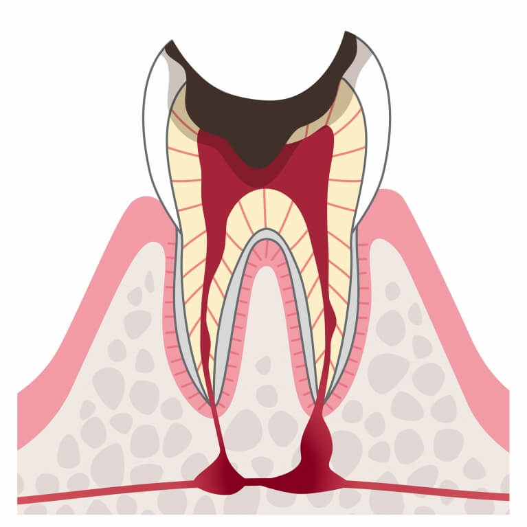 C4　末期のむし歯