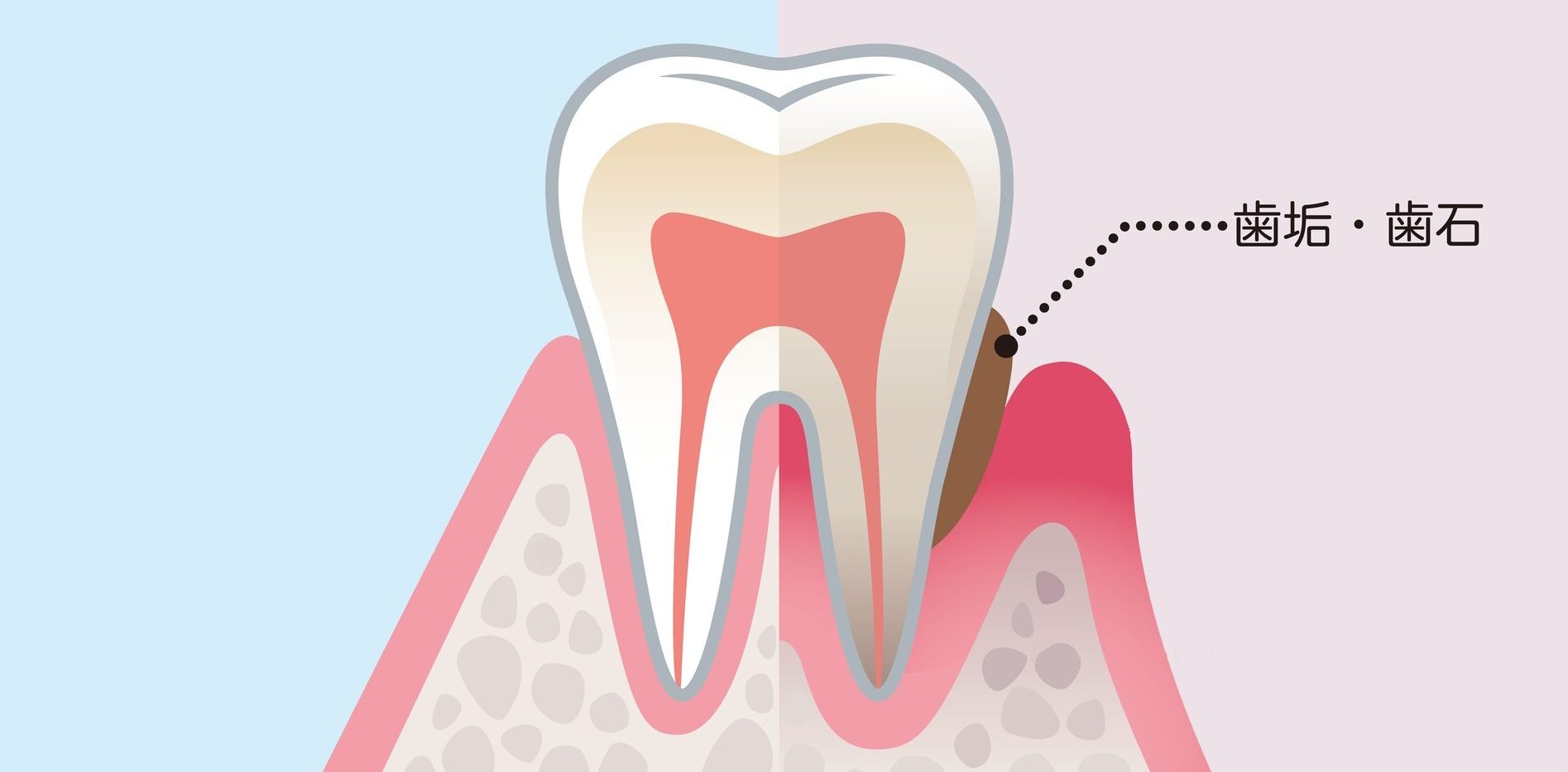 歯垢・歯石｜御茶ノ水プライムデンタル