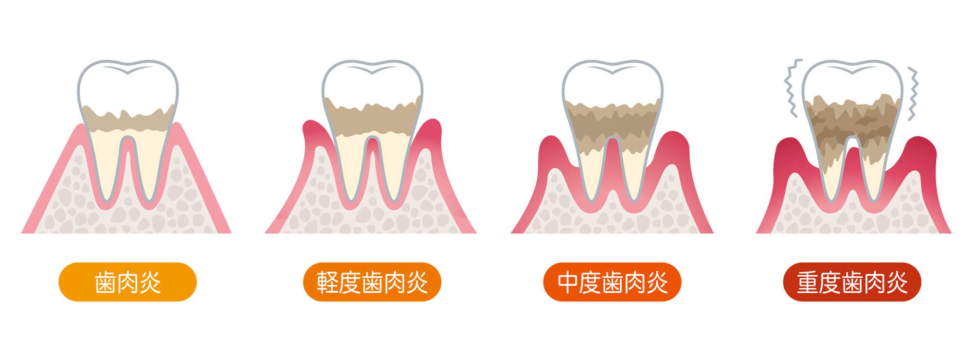 歯周病の症状｜御茶ノ水プライムデンタル