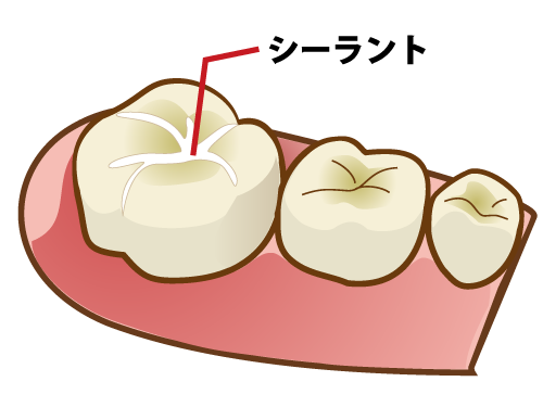 シーラント｜御茶ノ水プライムデンタル